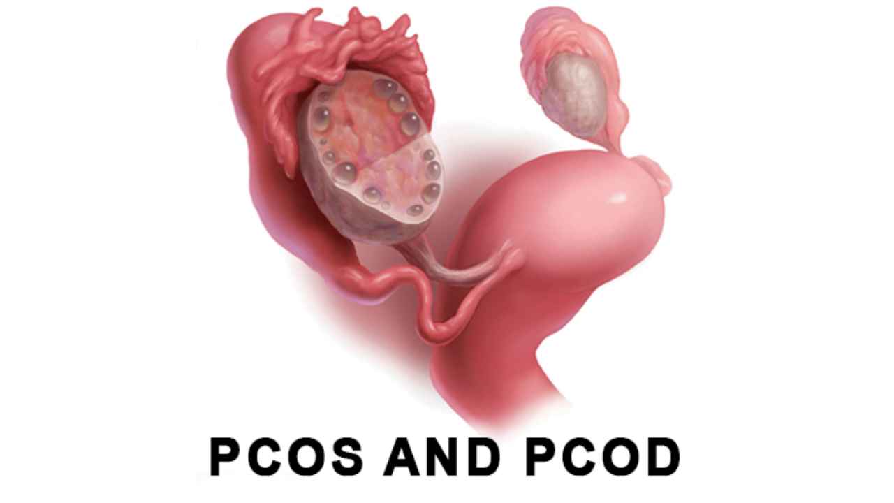 PCOD / PCOS – Causes, Symptoms, and Homeopathic Treatment by Dr. A K Mishra, Leading Homeopathy Doctor in Gorakhpur | पीसीओडी / पीसीओएस – कारण, लक्षण और होम्योपैथिक उपचार | डॉ. ए. के. मिश्रा, प्रमुख होम्योपैथिक डॉक्टर, गोरखपुर
